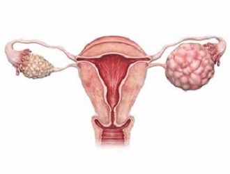 Service-Ovarian Tumor Laparoscopy