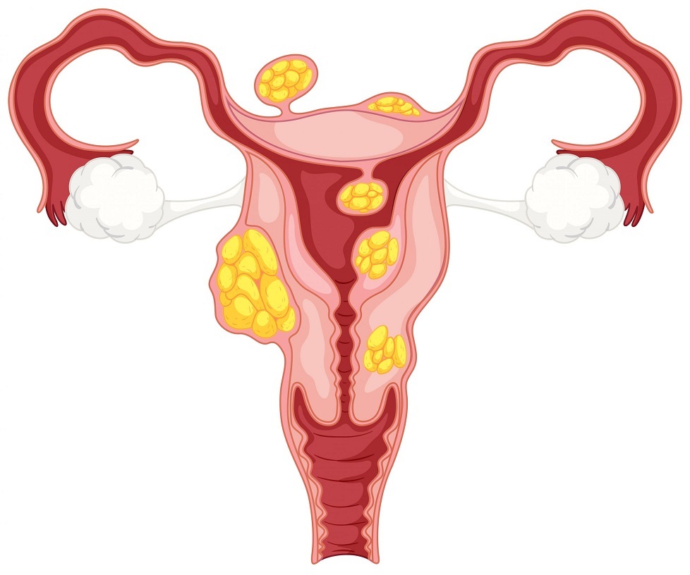 Laparoscopic Myomectomy in Nashik